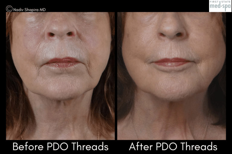 PDO Thread Lifts Wilmington & Near Me Facial Threading