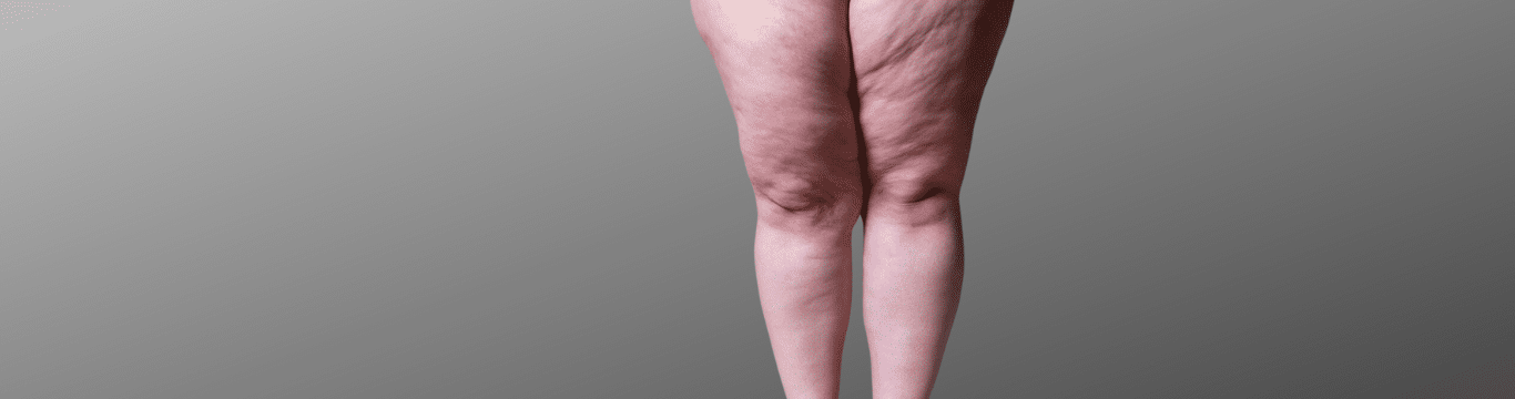 Lipedema Treatment for the Poorly Understood Disease