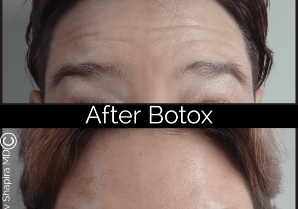 botox ba 455